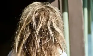 Widok z tyłu na blond włosy z widocznymi kołtunami. To nie jest choroba, ale efekt braku pielęgnacji.