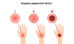 Ilustracja pokazuje stopnie poparzeń skóry: I - zaczerwienienie, II - bąble po opalaniu, III - głębokie uszkodzenie.