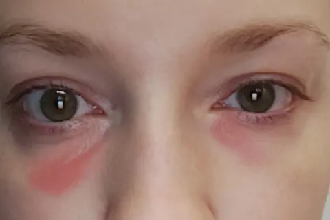 Czerwone plamy pod oczami, jakby po płaczu, ale to tylko kosmetyk.