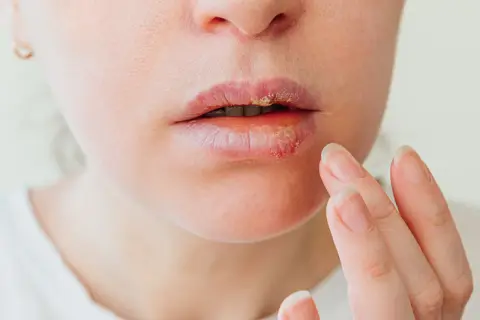 Usta z widocznymi, suchymi, popękanymi ustami i żółtawymi strupkami. Pojawiły się białe krostki na twarzy, które wymagają uwagi.
