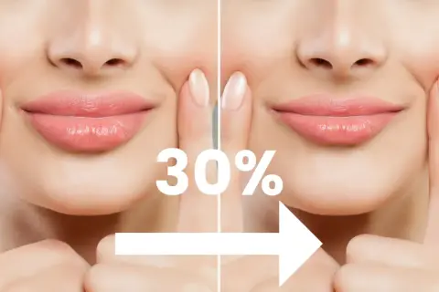 Usta po powiekszaniu. Porównanie przed i po zabiegu, widoczny efekt 30% większej objętości.