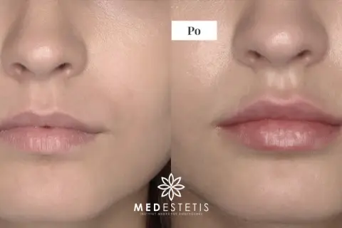 Przed i po modelowaniu ust kwasem hialuronowym. Usta stały się pełniejsze i bardziej zarysowane.