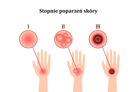 Ilustracja pokazuje stopnie poparzeń skóry: I - zaczerwienienie, II - bąble po opalaniu, III - głębokie uszkodzenie.