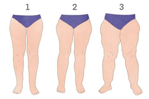 Ilustracja przedstawia trzy pary nóg o różnym stopniu lipodemi: 1 - łagodny, 2 - umiarkowany, 3 - zaawansowany.
