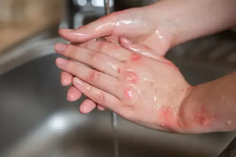 Pękająca skóra dłoni z ranami, które są myte pod bieżącą wodą.