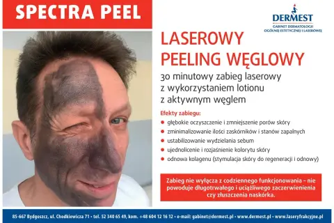 Laserowy peeling węglowy przed i po: połowa twarzy pokryta czarną maską węglową, druga połowa czysta. Efekty zabiegu widoczne.