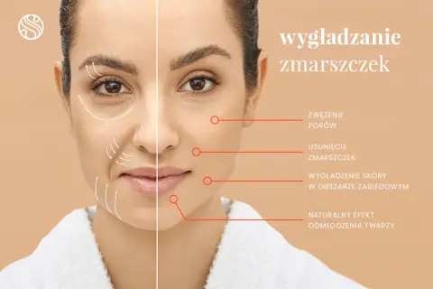 Kobieta z widocznymi zmarszczkami na twarzy, po zabiegu wygładzania. Strzałki pokazują poprawę skóry i redukcję zmarszczek.