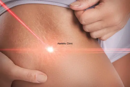 Skóra z rozstępami poddawana zabiegom laserowym w Aestetic Clinic.