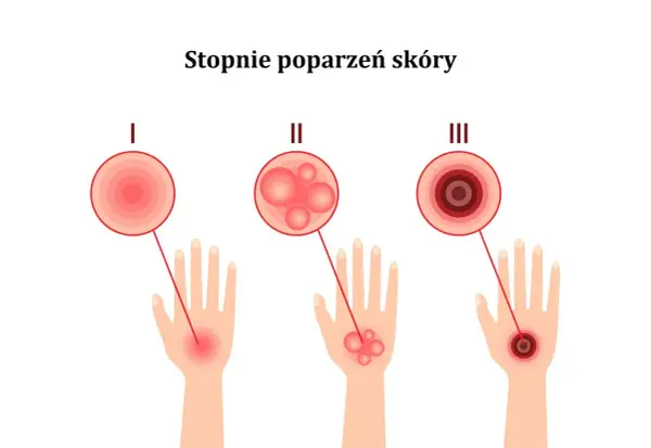 Ilustracja pokazuje stopnie poparzeń skóry: I - zaczerwienienie, II - bąble po opalaniu, III - głębokie uszkodzenie.